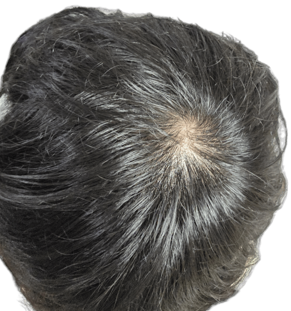 가마 쪽 탈모 상황 사진