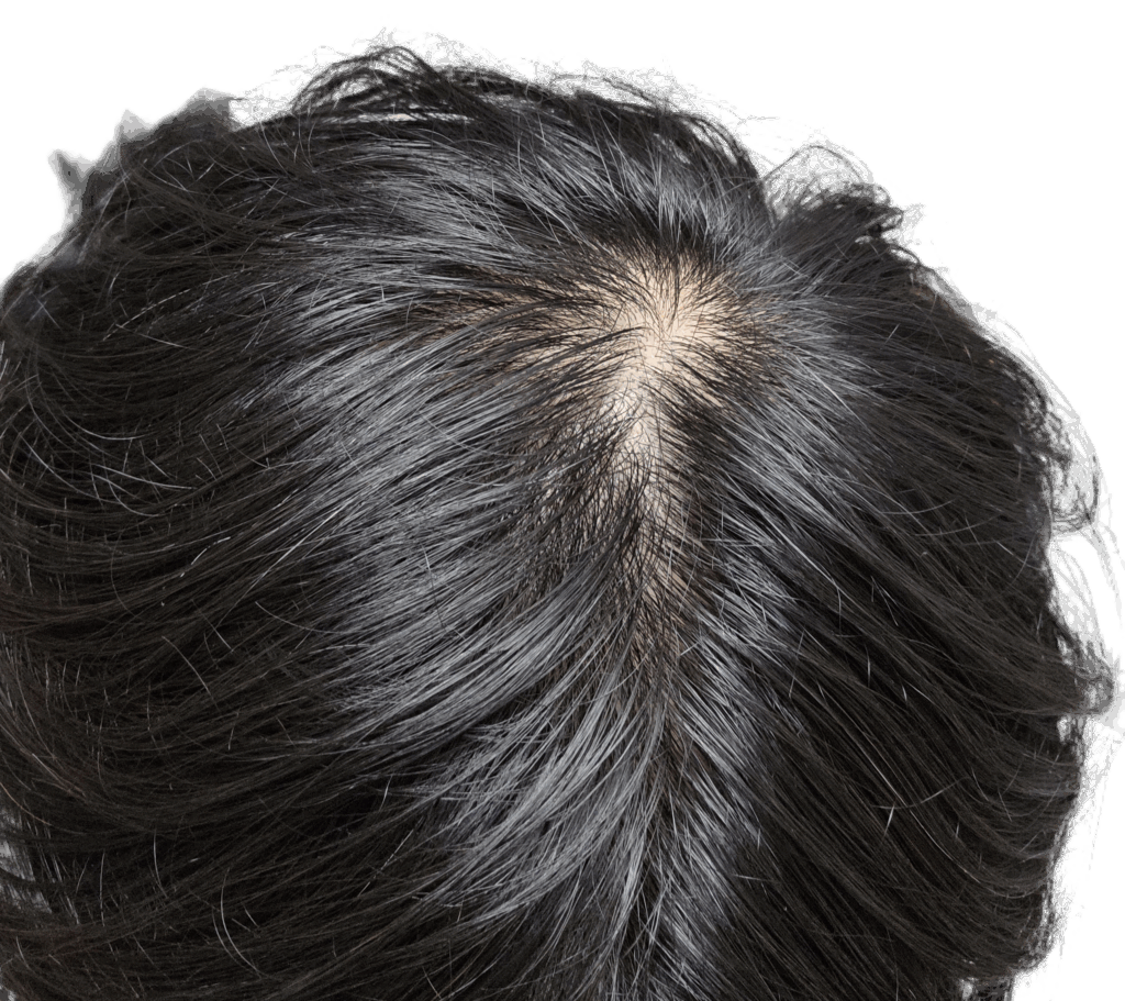 정수리 쪽 탈모 상황 사진